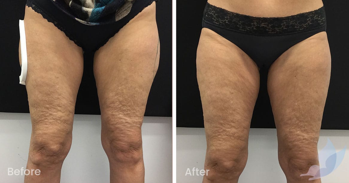 fat thighs before and after