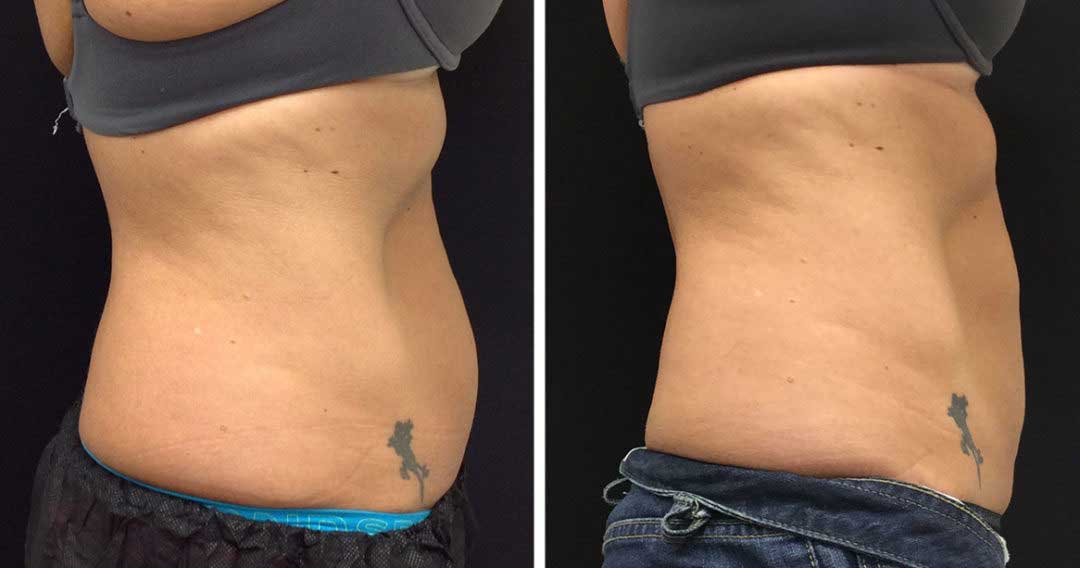 Cooltech Cryolipolysis Non Invasive Fat Reduction Austin Clinic