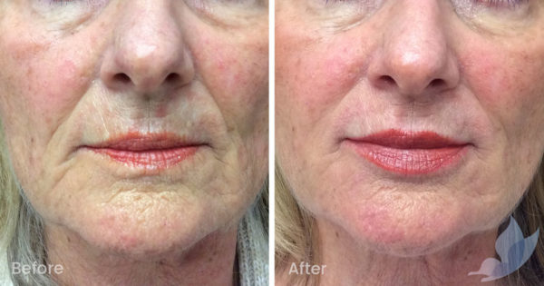 Fine Lines and Wrinkles - Lower Face - Austin Clinic