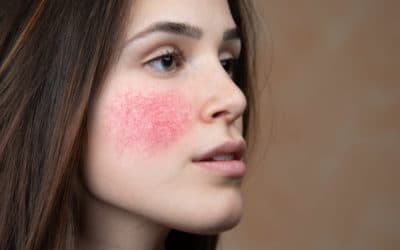 How to Know if It’s Redness or Rosacea