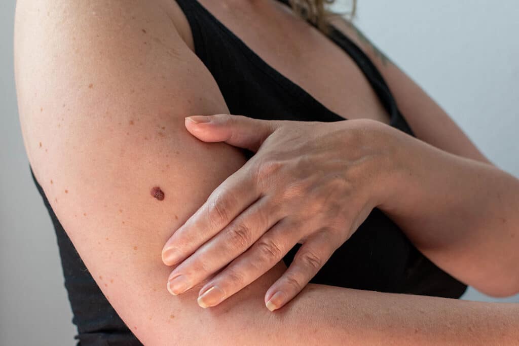 Woman with a small brown growth on her arm