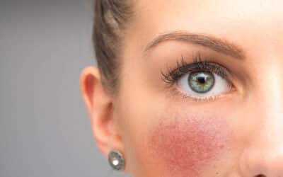 Which Winter Skincare Ingredients Worsen Rosacea?