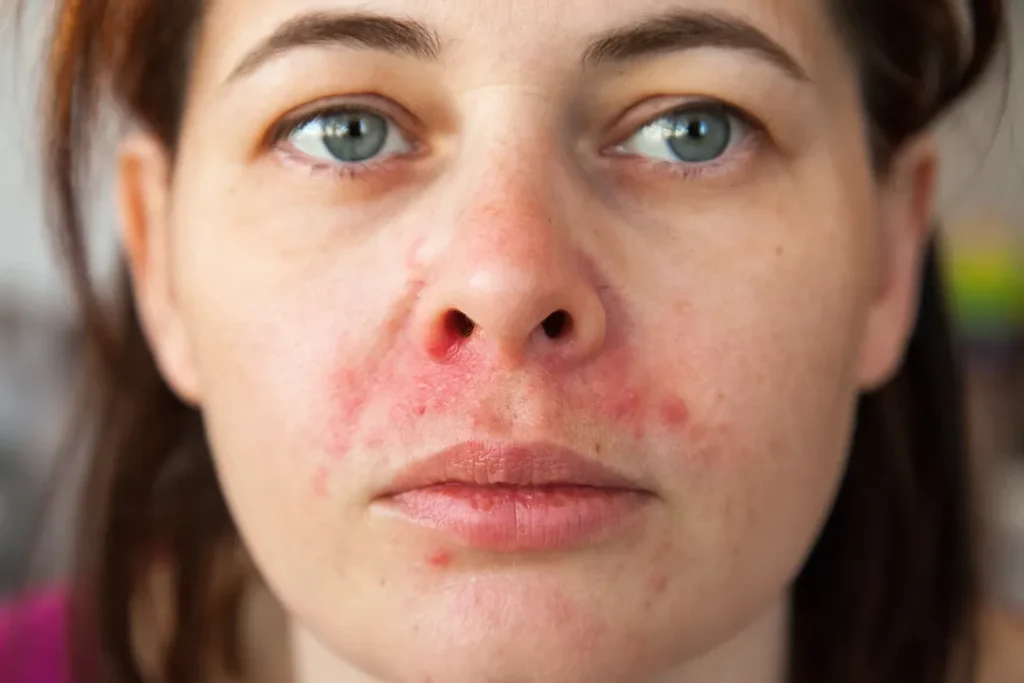 Woman's face with dermatitis