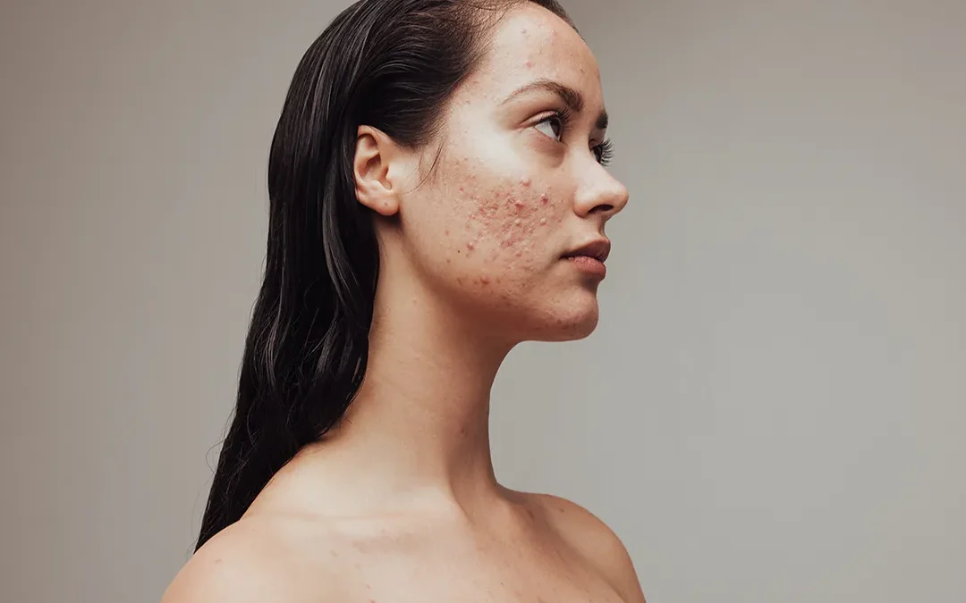 The Acne Apocalypse and Treatments That Work