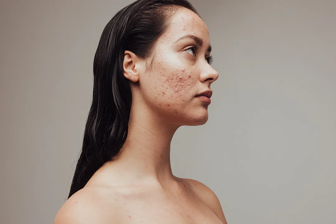 Young woman with acne on her face