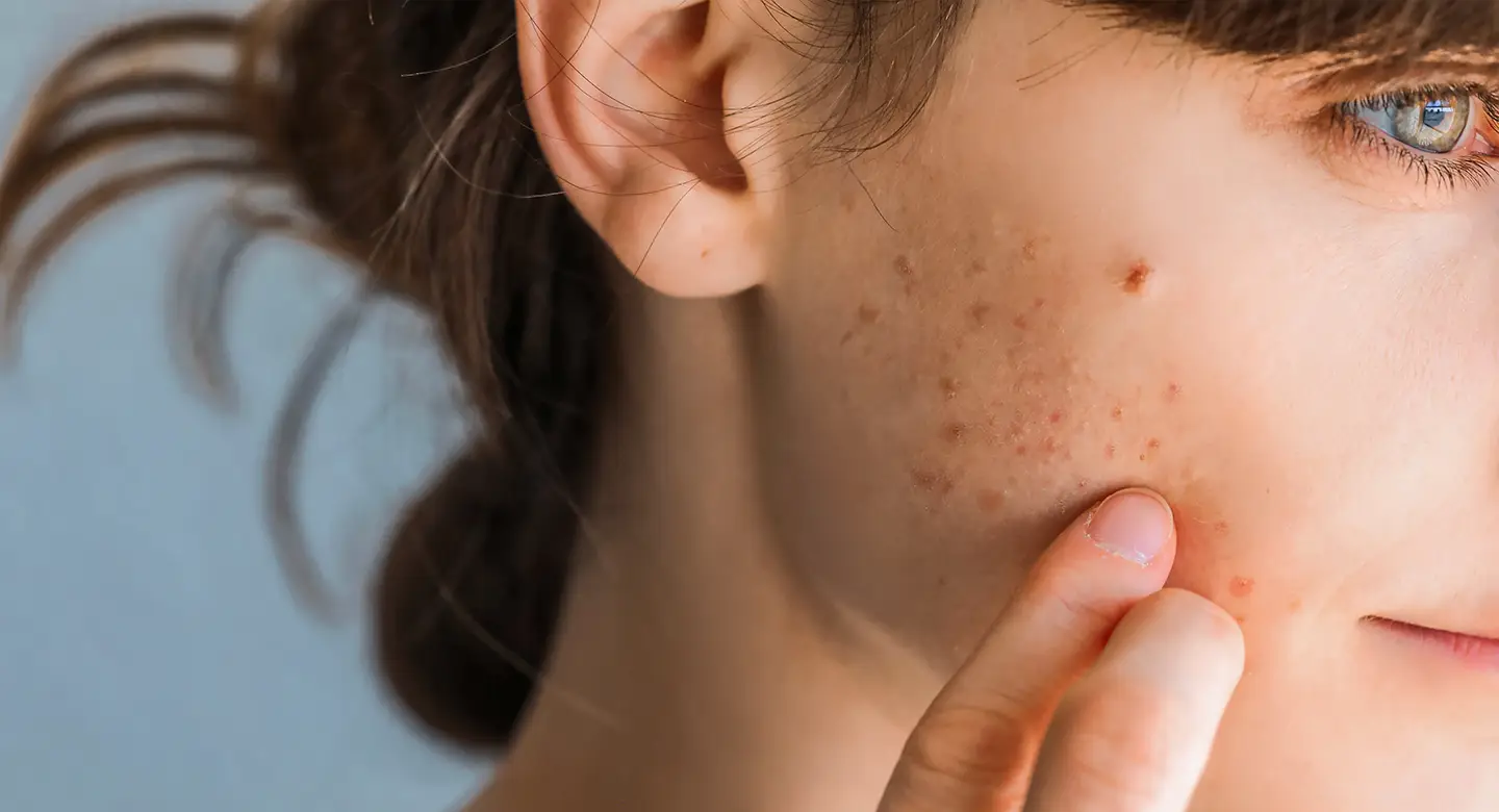 Young woman with acne on her face