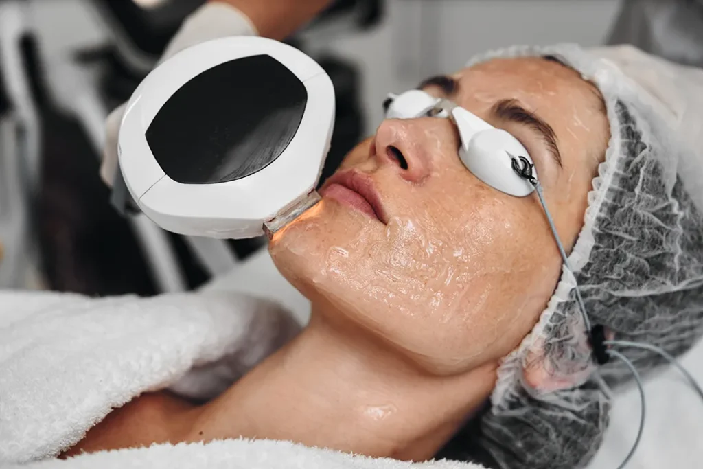 Woman wearing lead goggles while receiving IPL therapy