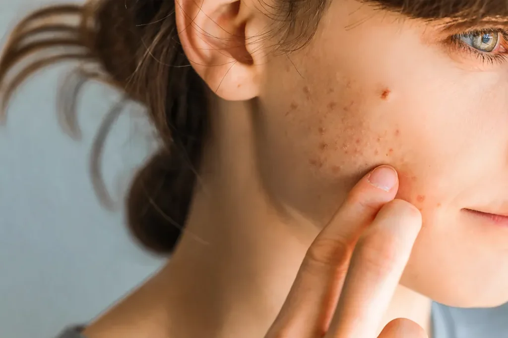 Young woman with skin damage touching her cheek